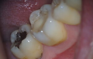 ダイレクトCR治療前