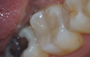 ダイレクトCR治療後