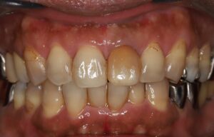 ウォーキングブリーチ治療前