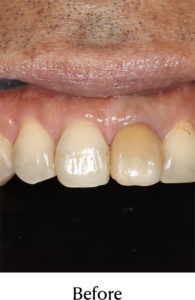 ウォーキングブリーチ術前