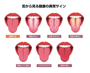 舌から見る健康の異常サイン