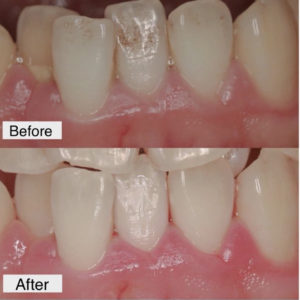 エアフロー術前後