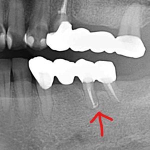 クラウンレングスニングオペ後