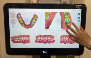 NIRIという口腔内スキャナー