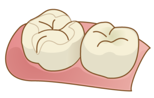 セラミックインレー