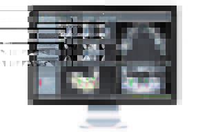 当院のインプラント「ガイドシステム」