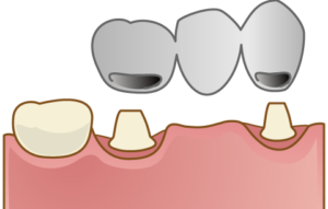 保険のクラウン型のブリッジ（奥歯用）