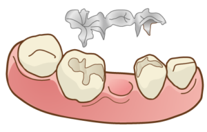 インレーブリッジ