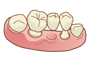 セラミックのブリッジ