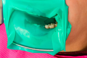 ラバーダム防湿