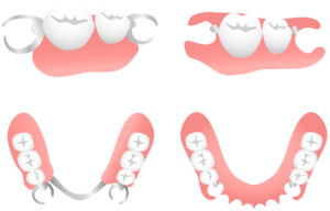 ノンクラスプデンチャー
