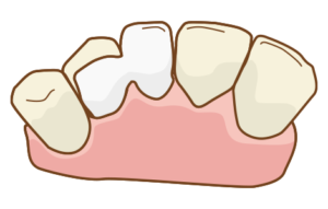 シングルリテンションブリッジ