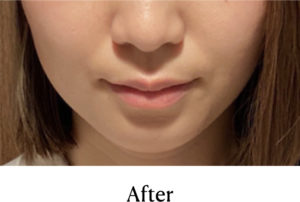 ボトックス治療術後