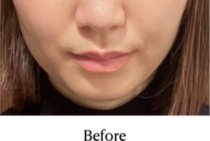 ボトックス治療術前