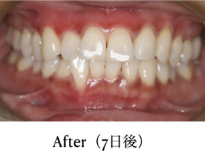 ガムピーリング施術7日後