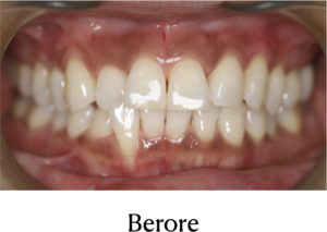 ガムピーリング施術前