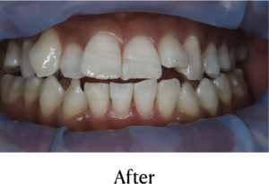 オフィスホワイトニング術後