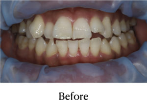 オフィスホワイトニング術前