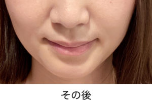 ボトックス治療その後