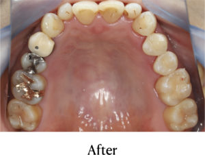 セラミックインレー治療後
