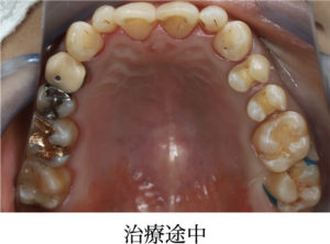 セラミックインレー治療経過