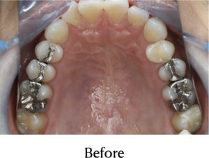 セラミックインレー治療前