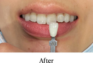 ホームホワイトニング術後