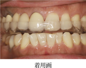 マウスピース着用画像