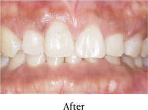 MTM+ダイレクトCR治療後