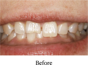 MTM+ダイレクトCR治療前