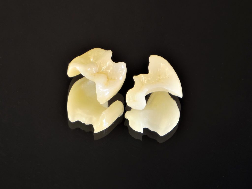 セラミックインレー