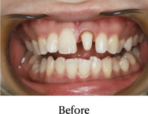 セラミッククラウン術前