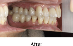 意図的再植法の治療後