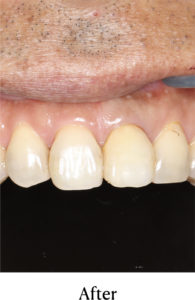 ウォーキングブリーチ術後