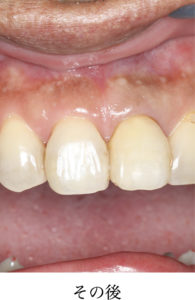 ウォーキングブリーチその後