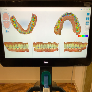 噛み合わせチェック機能