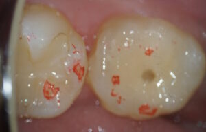 移植・歯冠修復後