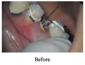 MTM（小矯正/エクストルージョン）治療中