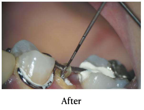 治療例：MTM（小矯正/エクストルージョン） | 初台の歯医者-ハニー歯科 