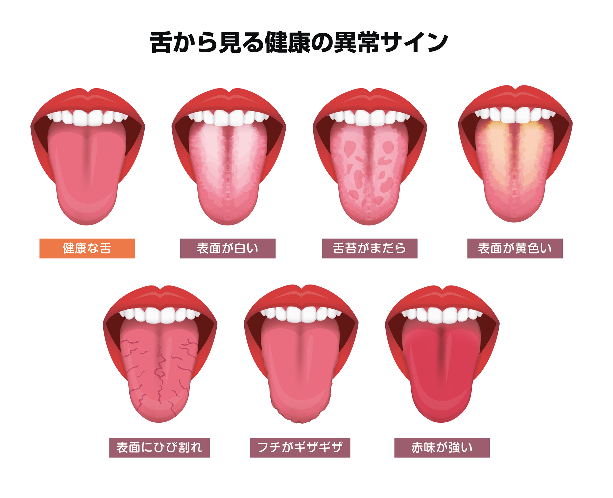 舌 の 表面 が 割れる
