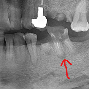 クラウンレングスニングオペ前